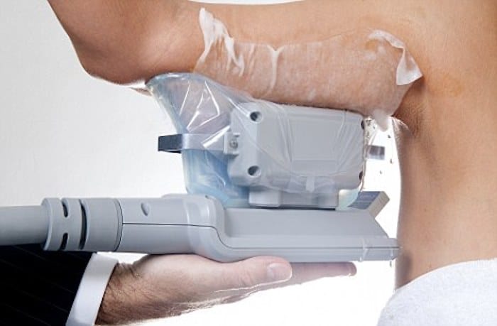 fat freezing arms Rhyl