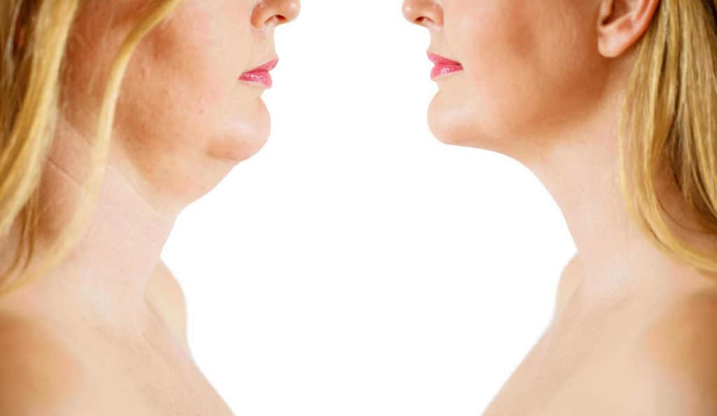 Double Chin treatment Rhyl before and after results