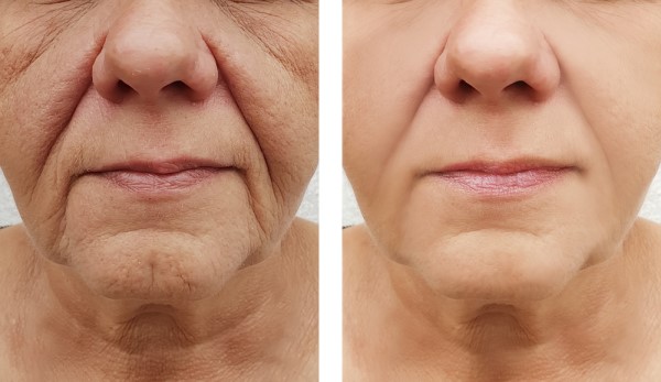 Learn more about Morpheus8 Treatment Rhyl today!