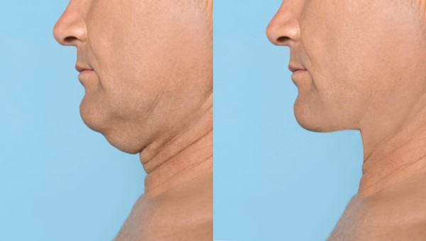 Which Non-Surgical Treatments Work Best for Jowls and Loose Skin Rhyl?