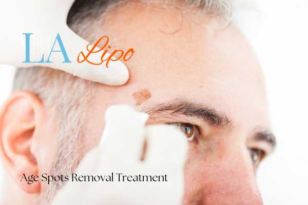 What Are the Most Effective Treatments for Age Spots Rhyl?