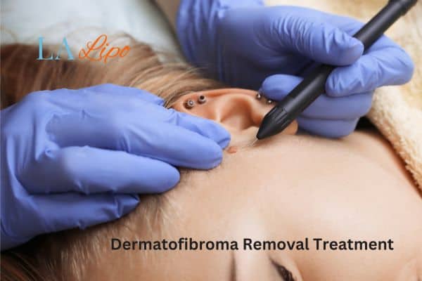 Dermatofibroma Removal Treatment Rhyl