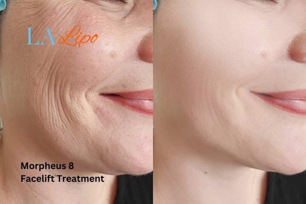 Morpheus8 Treatment Rhyl for flawless skin! Call us today!