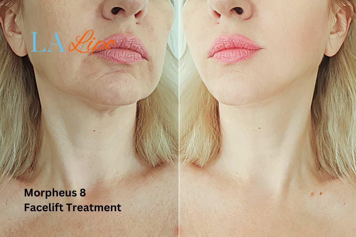 Turn back time with Morpheus8 Treatment Rhyl