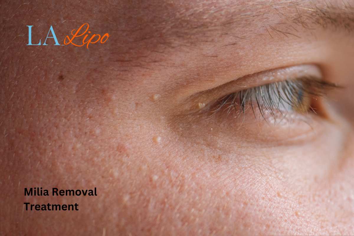 Cryopen Milia Removal: Is It the Easiest and Safest Option Rhyl?