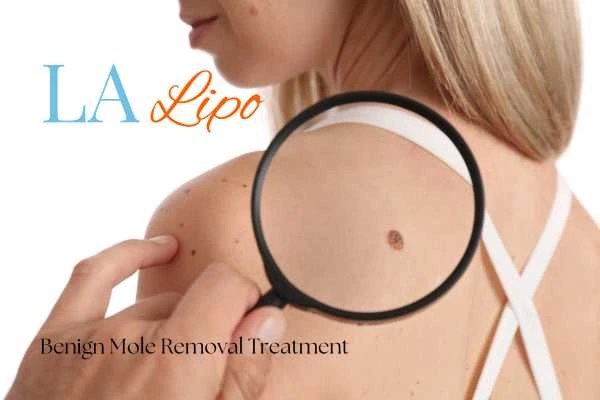 Woman having her inspection of blemish before mole removal Rhyl