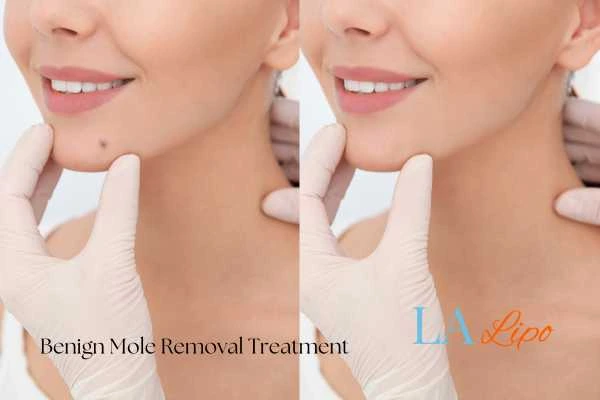 Before and after mole removal Rhyl treatment