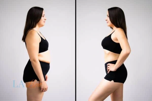 image of woman before and after results of LA-EMS Body Sculpting Rhyl to help treat Diastasis recti