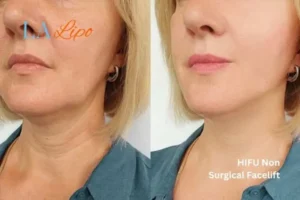 hi-fu for wrinkles Rhyl before and after results