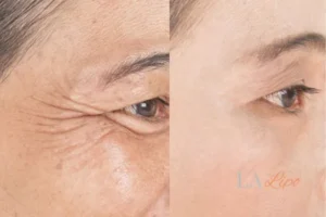 Before and after results of woman - HI-fu wrinkles reduction treatment Rhyl