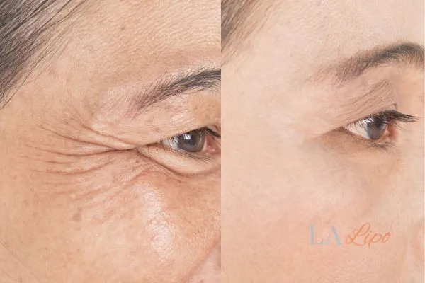 Before and after results of woman - HI-fu wrinkles reduction treatment Rhyl