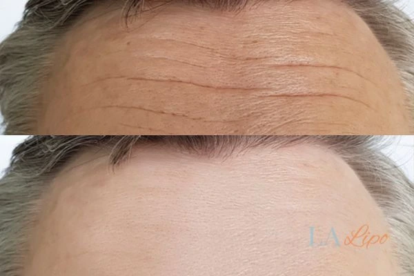 results of HIFU Rhyl on mans forehead to help reduce lines and wrinkles
