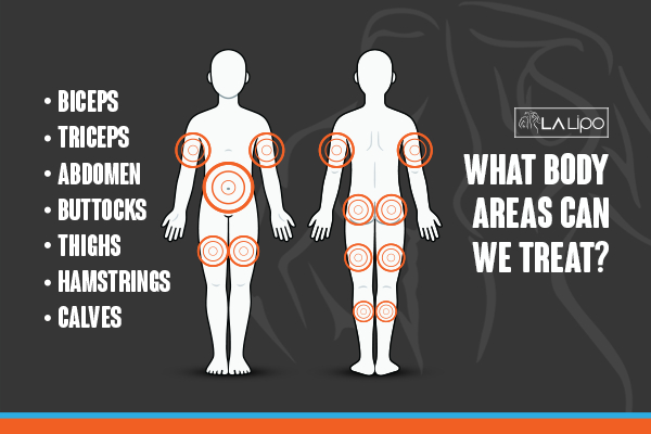 Graphic to show areas you can have LA-EMS Body Sculpting Rhyl treatment.