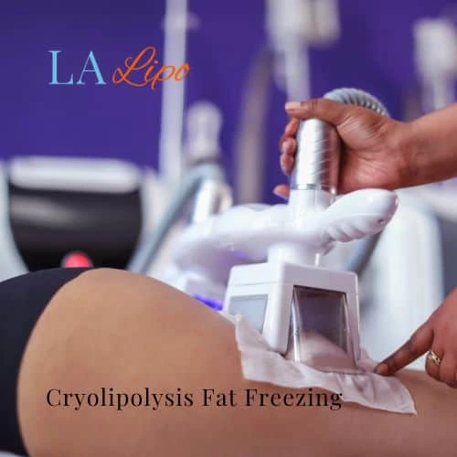 fat freezing - Cryolipolysis Rhyl