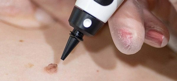skin tag removal using cryopen Rhyl