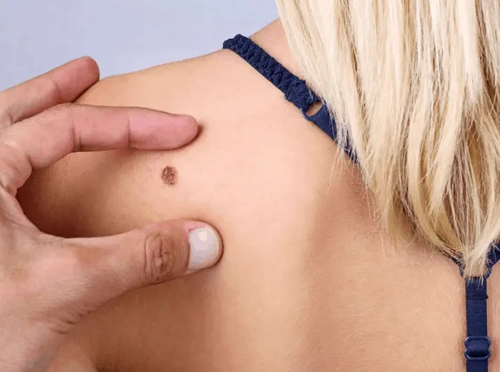woman having mole removal Rhyl consultation before treatment.