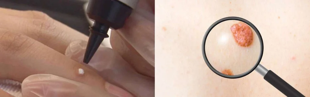 Person getting moles removed with cryopen Rhyl