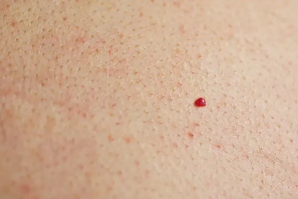 close up of a cherry angioma Rhyl