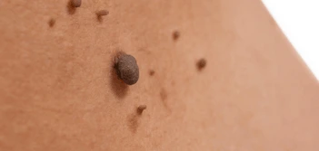 image of a skin tag Rhyl