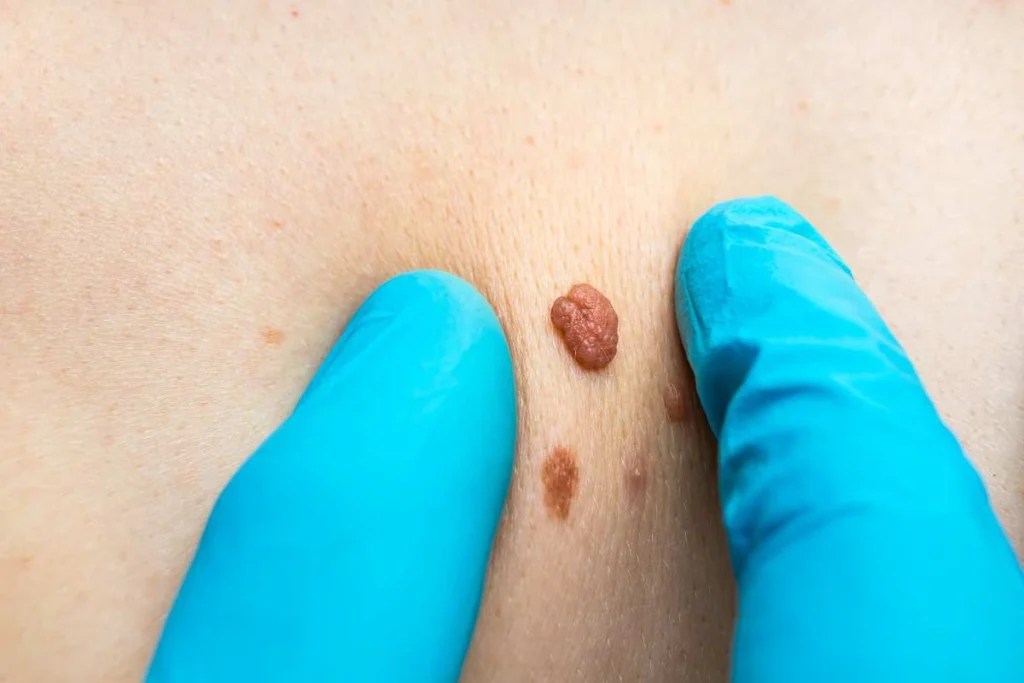 Consultant examining a skin tag Rhyl