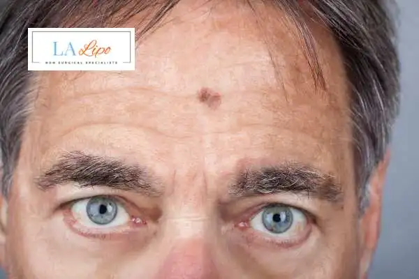 Solar Lentigo Removal Rhyl image of man with mark on his forehead