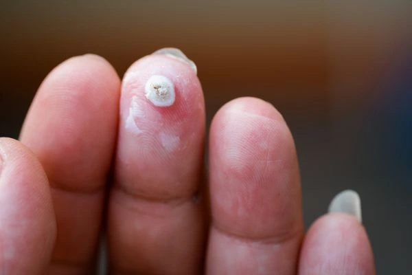 wart on person finger - cryotherapy to treat from LA LIPO Rhyl