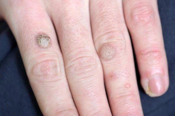 photo of warts on person hand - see wart removal Rhyl from LA LIPO