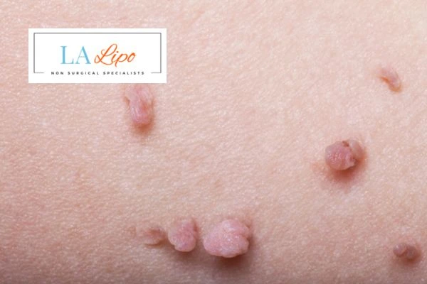 Does cryopen skin tag removal Rhyl hurt? Find out now call our team today!