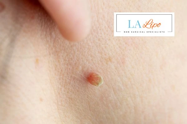 Book skin tag removal Rhyl today speak to our team now!