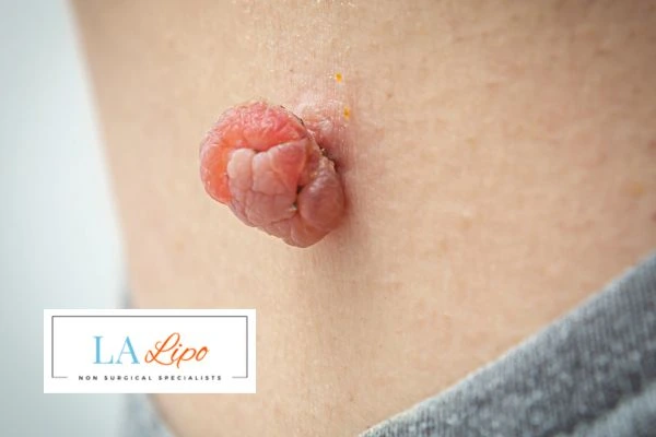 Interested in skin tag removal Rhyl? Concerned about the pain? Find out more today!
