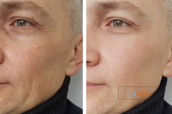See the amazing results of Morpheus8 Treatment Rhyl!