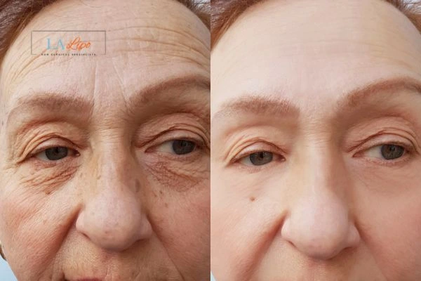 The powerful benefits of Morpheus8 Treatment Rhyl - Call Our team today!