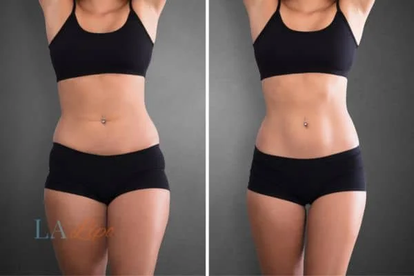 before and after results of non-surgical treatment to help a woman's body image and mental health Rhyl
