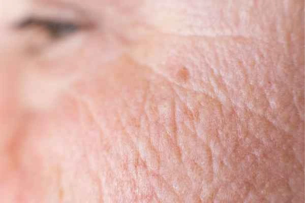 close up picture of a woman's face showing an age spot Rhyl