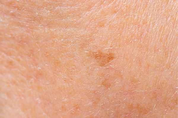 close up picture of age spots Rhyl