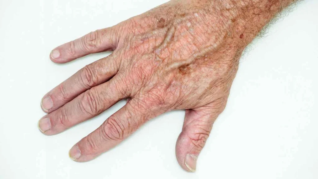 Male hand showing age spot Rhyl