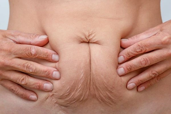 Should I Combine Diastasis Recti Treatment with Body Contouring for Better Results Rhyl?