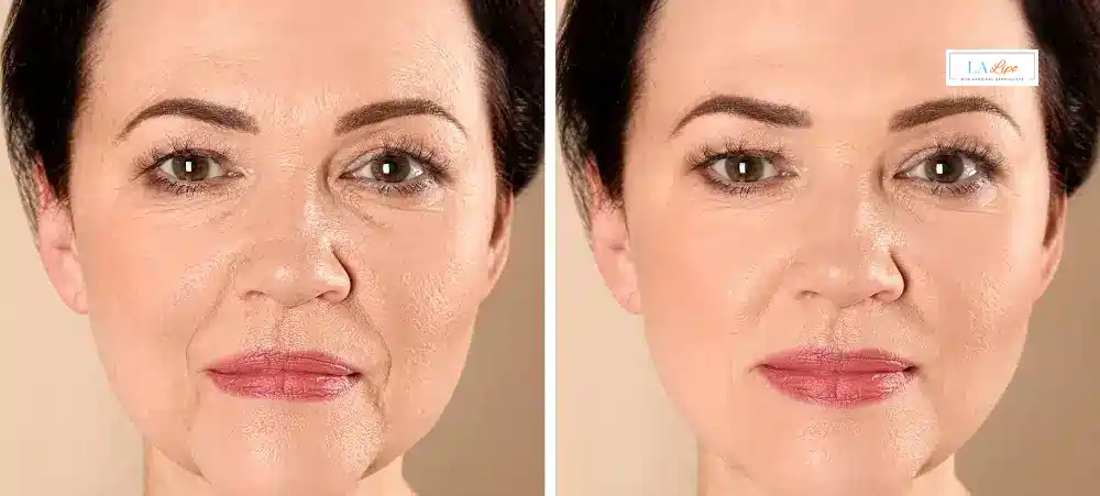 How Long Does It Take to See Results and How Long Do They Last Rhyl?