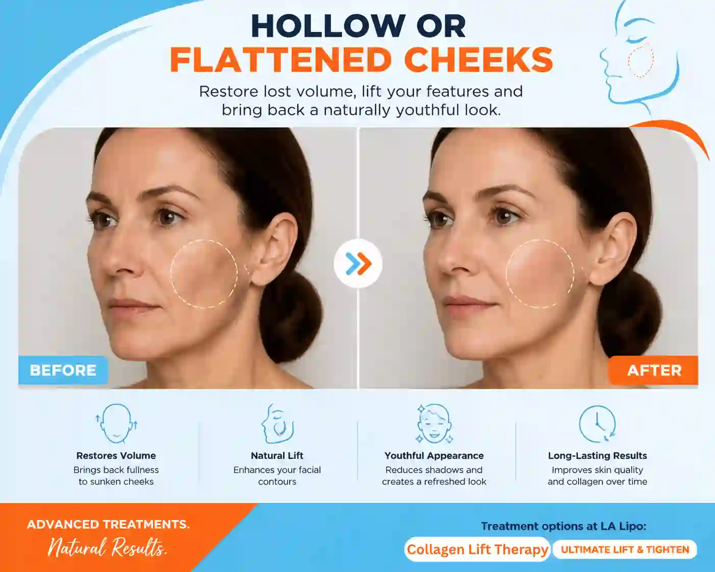 Sign #4: Hollow or Flattened Cheeks Rhyl