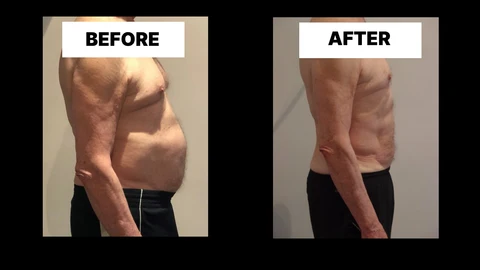 What Symptoms Can Diastasis Recti Cause in Men? Weak Core, Back Pain and Poor Posture Rhyl